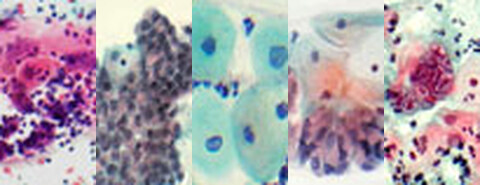 Five stained cytology samples side by side, from the IACC EQA website in 2007